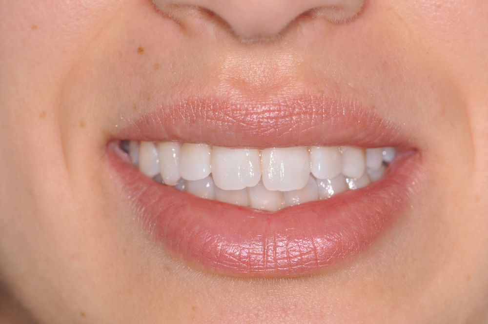 Sorriso bianco di una cliente dello studio Federica Ercoli
