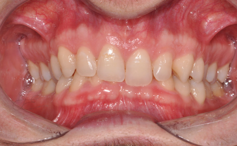 Bocca prima del trattamento ortodontico